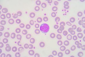 Tout savoir sur la lymphocytose